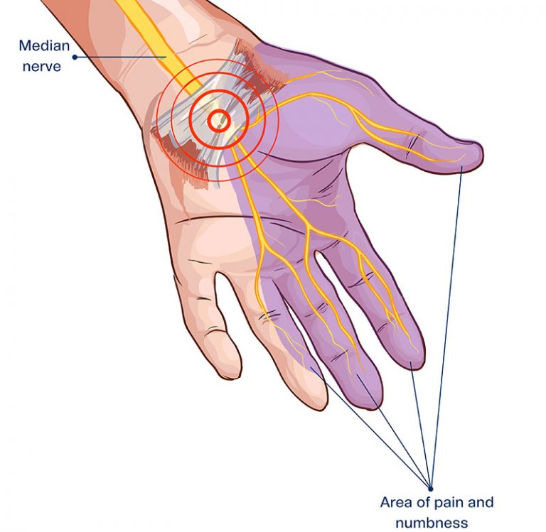 Carpal Tunnel Syndrome | Pain Specialist - Phoenix, Scottsdale, Peoria