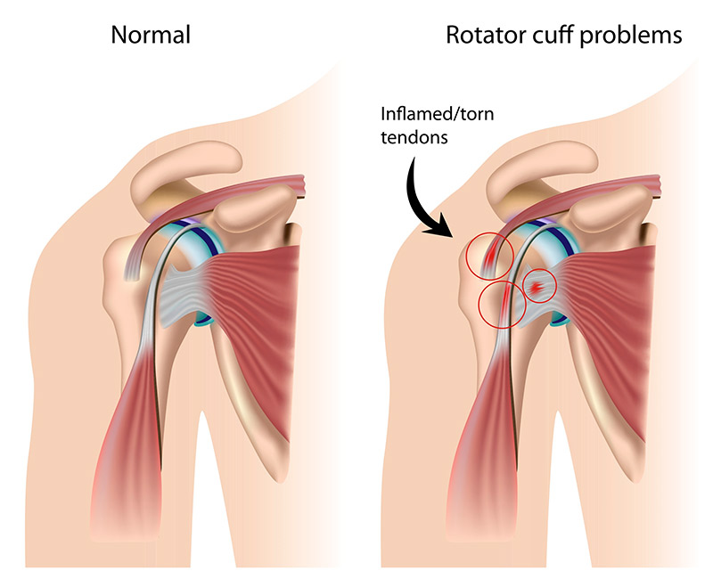 Rotator Cuff Tear & Related Pain Treatment from Summa Pain Care