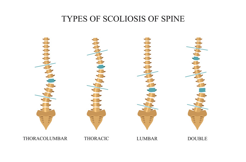 Scoliosis Treatment from Summa Pain Care