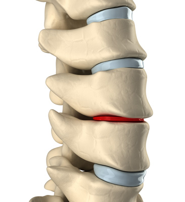 Summa Pain Care - Spinal Arthritis