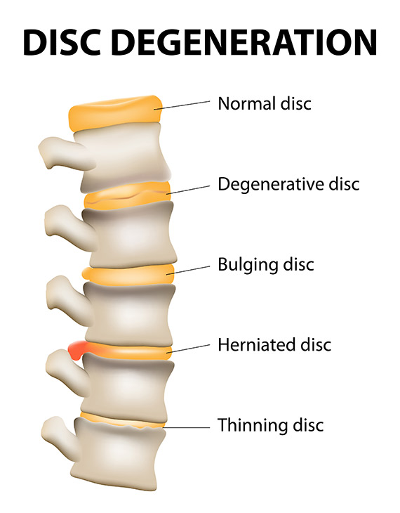 Disc Displacement & Radiculopathy